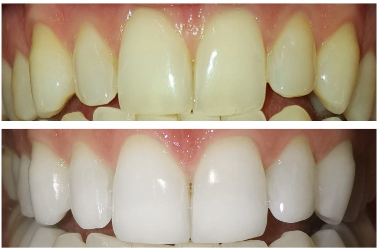 Arcata superiore pre e post trattamento