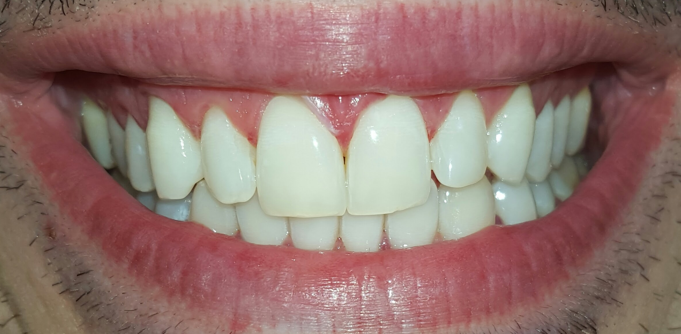 Risultato finale sorriso completo