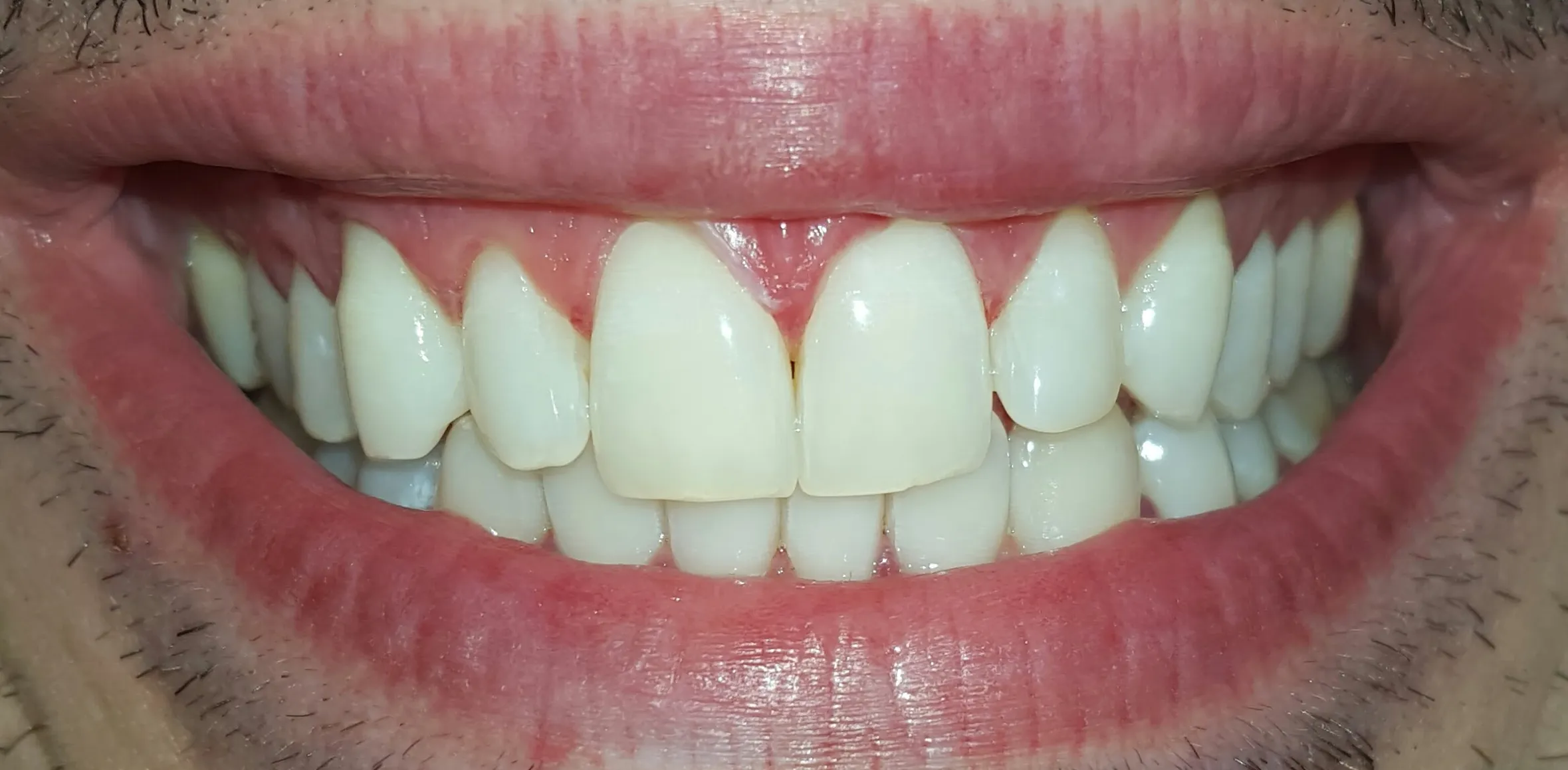 Risultato finale sbiancamento denti professionale Bergamo - sorriso completo