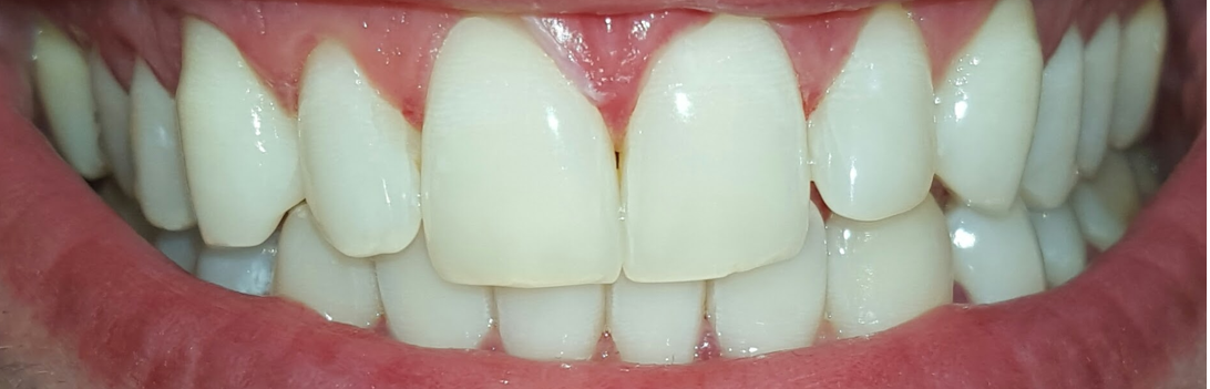 Risultato sbiancamento denti dopo 10 giorni