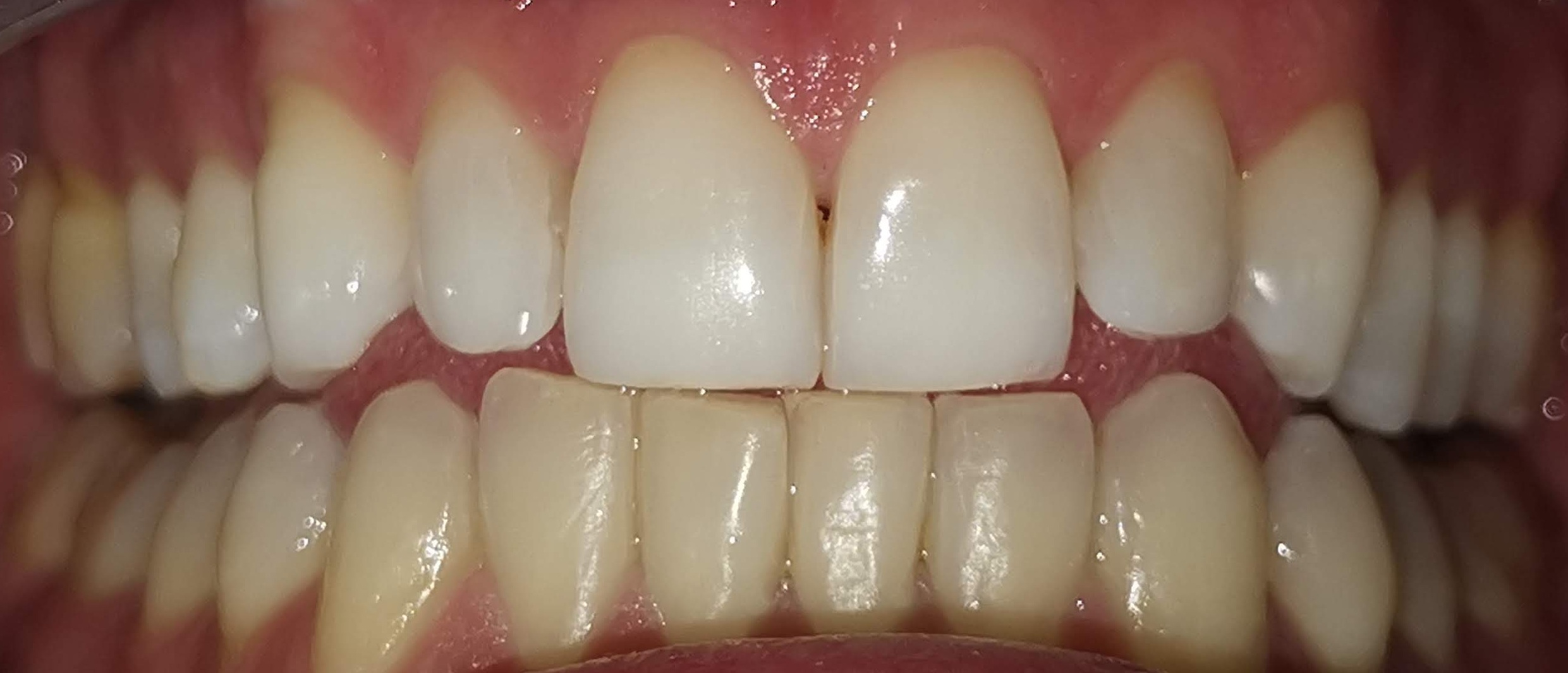 Arcata superiore sbiancata vs inferiore