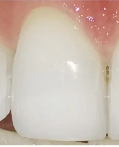 Dente dopo sbiancamento denti Bergamo