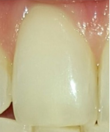 Dente singolo pre