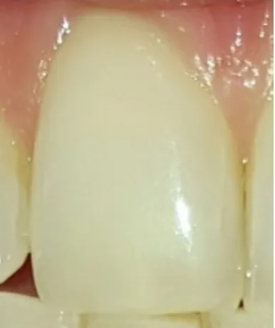 Dente prima dello sbiancamento professionale